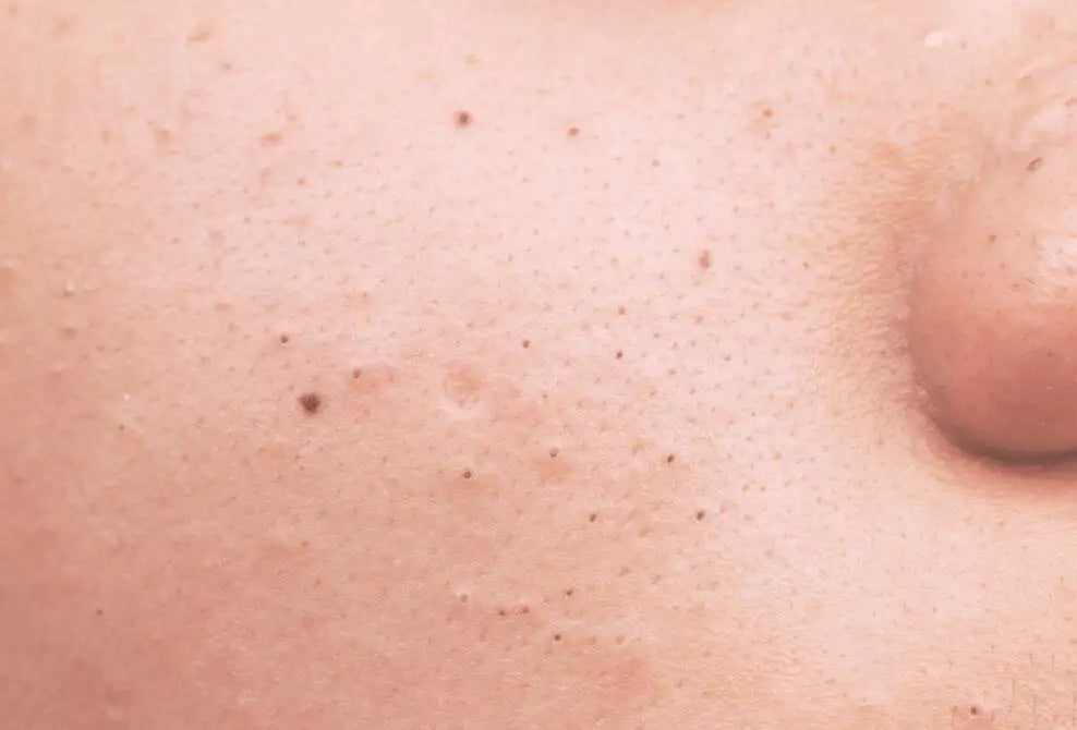 Blackheads: what are they and how do I treat them?